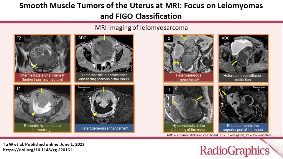 RadioGraphics_Editor (@radg_editor) on Twitter photo Smooth Muscle Tumors of the Uterus at MRI: Focus on Leiomyomas and FIGO Classification
Tu W et al
Obstetric & Gynecology Imaging
doi.org/10.1148/rg.220…
<a href="/WendyTuMD/">Wendy Tu, MD</a>
<a href="/motoyoyanomdphd/">Motoyo Yano, MD, PhD</a>
<a href="/SatheeshToronto/">Satheesh Krishna</a>
<a href="/RadRaviG/">Ravi Gottumukkala, MD</a>
<a href="/NickSchiedaMD/">NickSchieda</a>
@RaquelScientia
#RGphx
9/12 Smooth Muscle Tumors of the Uterus at MRI: Focus on Leiomyomas and FIGO Classification
Tu W et al
Obstetric & Gynecology Imaging
doi.org/10.1148/rg.220…
<a href="/WendyTuMD/">Wendy Tu, MD</a>
<a href="/motoyoyanomdphd/">Motoyo Yano, MD, PhD</a>
<a href="/SatheeshToronto/">Satheesh Krishna</a>
<a href="/RadRaviG/">Ravi Gottumukkala, MD</a>
<a href="/NickSchiedaMD/">NickSchieda</a>
@RaquelScientia
#RGphx
9/12