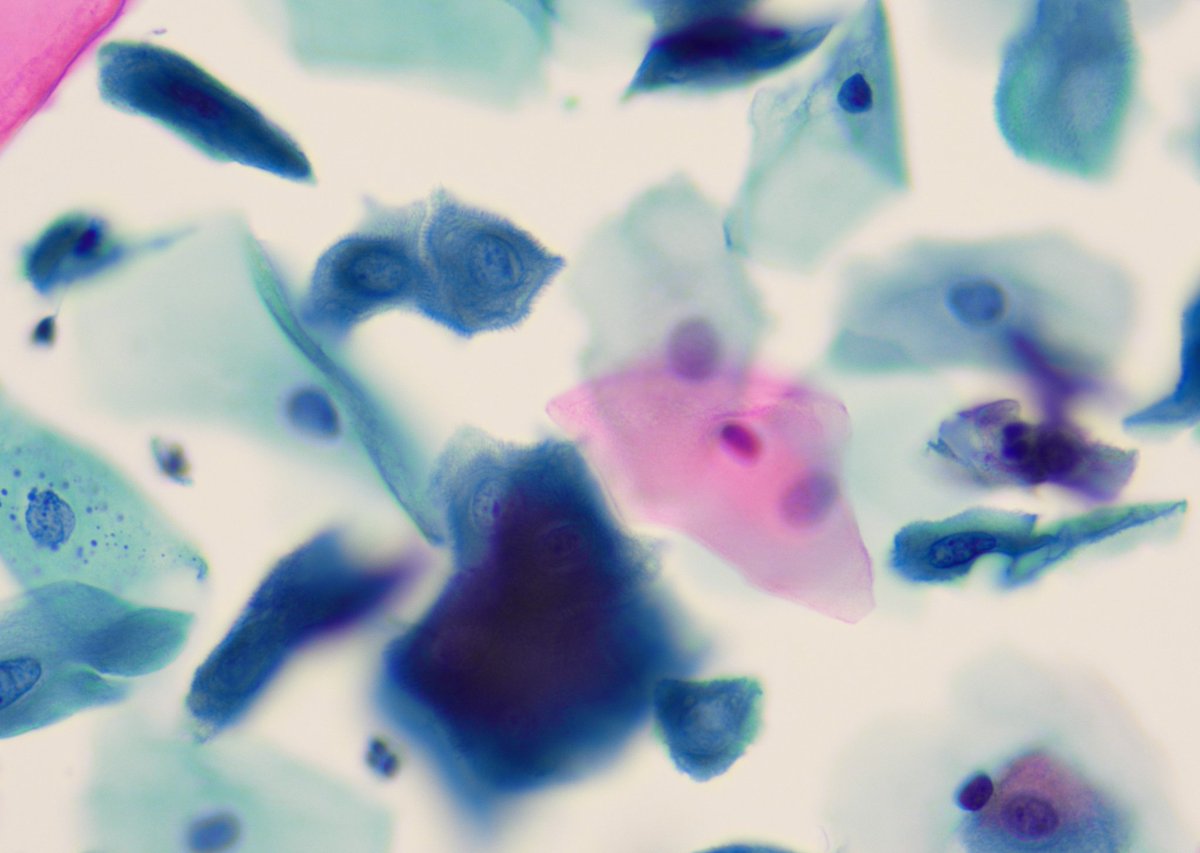 Evgeniya Kozorezova (@9nr1kcdfuhg9ryo) on Twitter photo Cytological riddle. F, 31 yo. cervical sample (LBC). No HPV HR or LR, no HSV now or in the past, normal colposcopy. But we've found strange changes in the epithelium. Your version?
<a href="/ElmiraKomissar6/">Elmira Komissarova</a> <a href="/antonietagalvao/">Maria Antonieta Longo Galvao MD PHD</a> <a href="/elsa_borisova/">Elza Borisova</a> <a href="/pepeheffernan/">Pepe Jiménez Heffernan</a> <a href="/atman_ci/">Dr. Luca</a> <a href="/edusqo/">Eduardo Alcaraz, MD PhD</a> <a href="/nucleololailo/">Carlos Miguel Ruiz</a> Cytological riddle. F, 31 yo. cervical sample (LBC). No HPV HR or LR, no HSV now or in the past, normal colposcopy. But we've found strange changes in the epithelium. Your version?
<a href="/ElmiraKomissar6/">Elmira Komissarova</a> <a href="/antonietagalvao/">Maria Antonieta Longo Galvao MD PHD</a> <a href="/elsa_borisova/">Elza Borisova</a> <a href="/pepeheffernan/">Pepe Jiménez Heffernan</a> <a href="/atman_ci/">Dr. Luca</a> <a href="/edusqo/">Eduardo Alcaraz, MD PhD</a> <a href="/nucleololailo/">Carlos Miguel Ruiz</a>