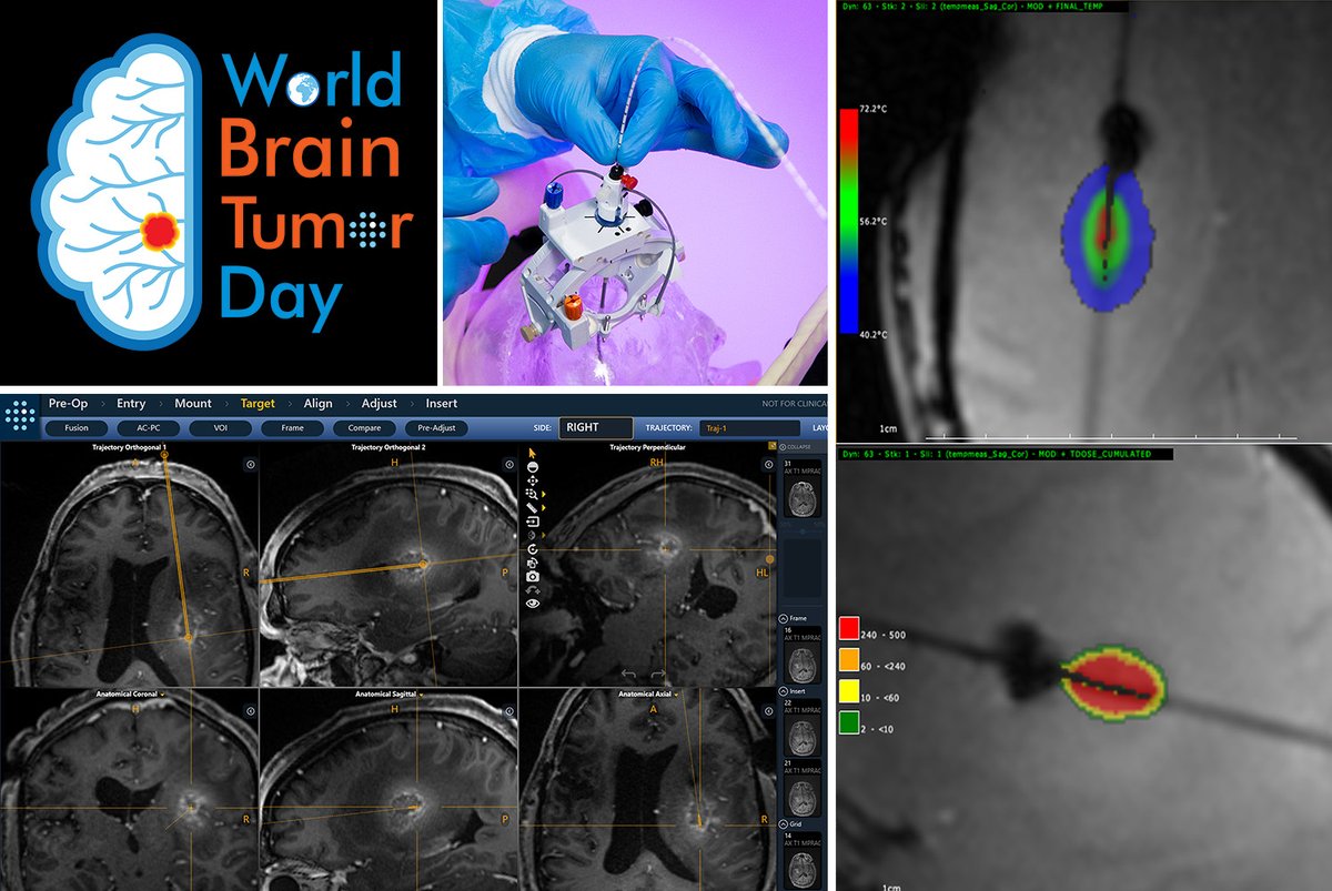ClearPointNeuro's tweet image. We&apos;ve supported 850+ cases guiding #Biopsy, #LaserTherapy &amp;amp; #CellAndGeneTherapy in #ClinicalTrials. With our ClearPoint Prism Neuro Laser Therapy System, we’re delighted to offer our 1st therapeutic device to help patients w/ #BrainTumors. #WorldBrainTumorDay #NeuroOncology #CLPT