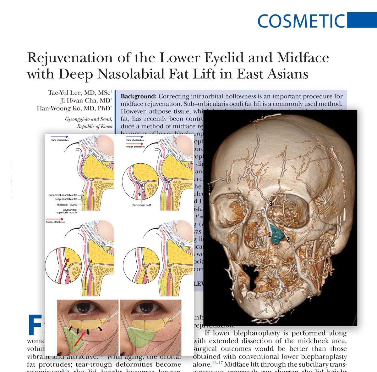 The objective of this #PRSJournal study was to introduce a method of midface rejuvenation using deep nasolabial fat lift (MRDN) by means of lower #blepharoplasty &amp; to compare surgical outcomes between MRDN &amp; lower blepharoplasty with fat transposition. bit.ly/MidliftLifts