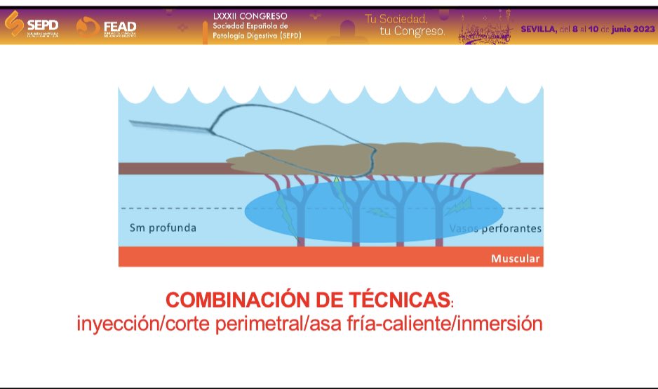 digestivomadrid (@digestivomadhm) on Twitter photo Mañana estaremos #CongresoSEPD23 <a href="/sepdigestiva/">Sociedad Española de Patología Digestiva (SEPD)</a>
Un recorrido por la evolución de la polipectomia y terminaremos con tecnología de fusión para endoscopia terapéutica. Viaja con nosotros. Te esperamos
👉 9 de junio a las 15 horas, Sala Andalucía 6 Mañana estaremos #CongresoSEPD23 <a href="/sepdigestiva/">Sociedad Española de Patología Digestiva (SEPD)</a>
Un recorrido por la evolución de la polipectomia y terminaremos con tecnología de fusión para endoscopia terapéutica. Viaja con nosotros. Te esperamos
👉 9 de junio a las 15 horas, Sala Andalucía 6
