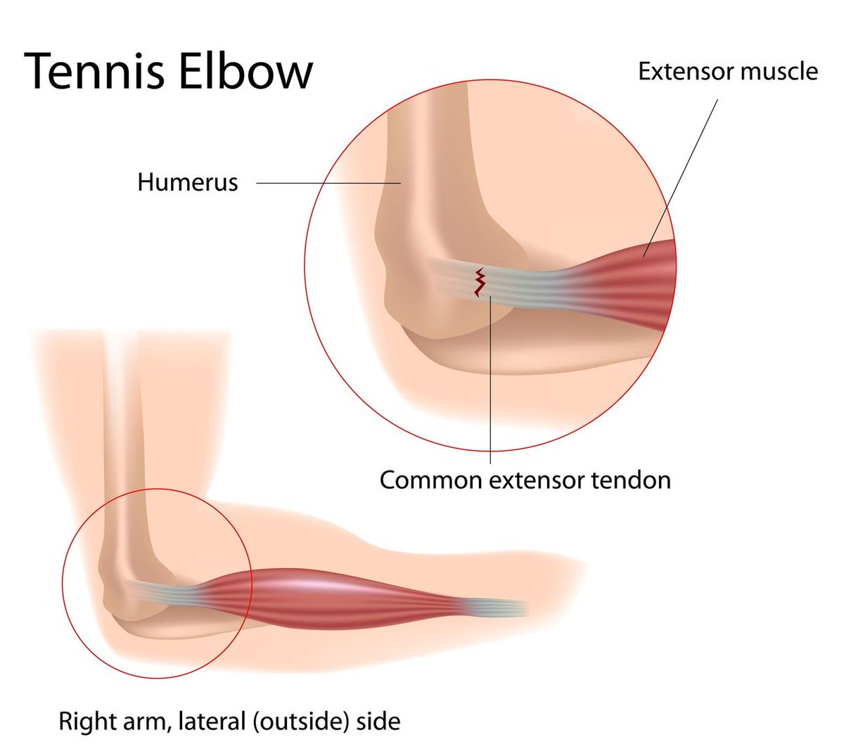 Tennis Elbow - Definition, Anatomy and Causes - Jeffrey H. Berg, M.D. bit.ly/3cZh74J #TennisElbow #LateralEpicondylitis #ElbowPain