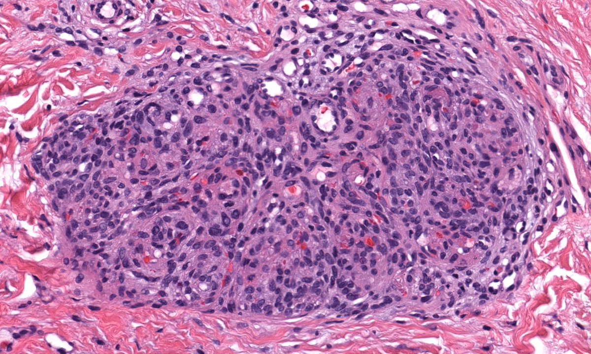 12 yo boy. Slowly growing violaceous plaque on back since birth.
WSI digital slide: kikoxp.com/posts/11805
Answer: kikoxp.com/posts/12127
Video: kikoxp.com/posts/7911
#pathology #pathologists #pathTwitter #dermpath #dermatology #dermatologia #dermtwitter #BSTpath #pedipath