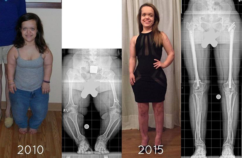 Somos Cosmos on Twitter "Un paciente con acondroplasia (enanismo) antes y después de los