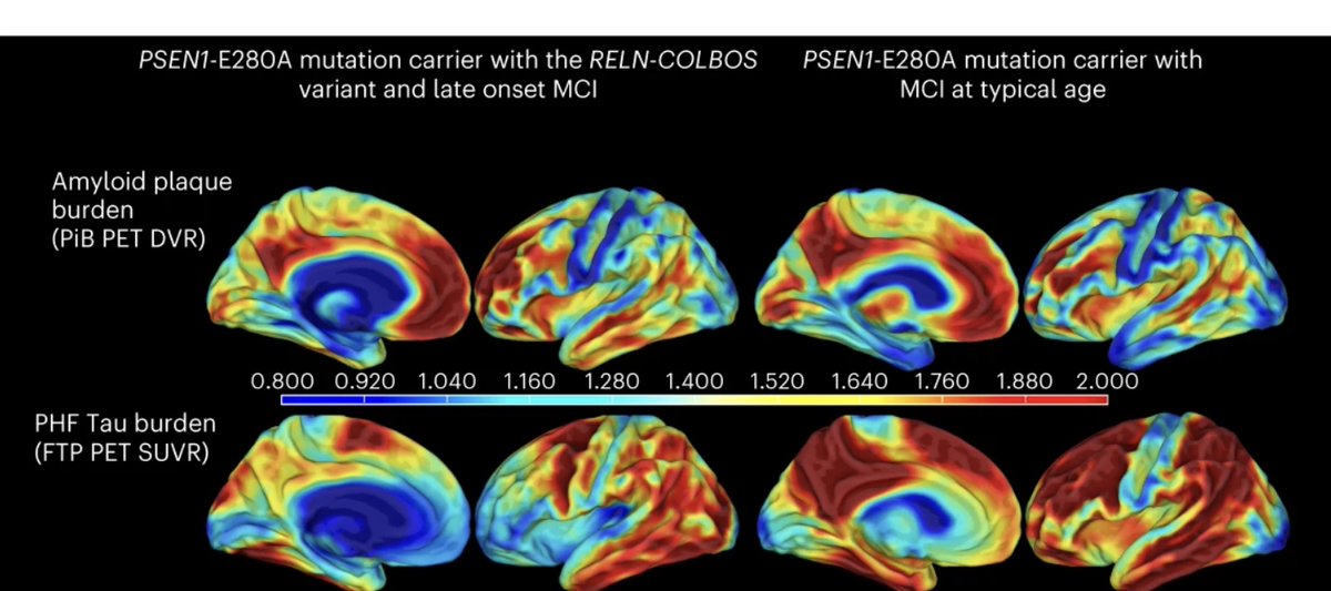 There is a big excitement about Nature paper by Lopera et al. published on May 15.  Development of Alzheimer disease and resulting dementia involves the emergence and growth of amyloid plaque that impedes the function of neurons.  After regulatory dysregulation leads to plaque