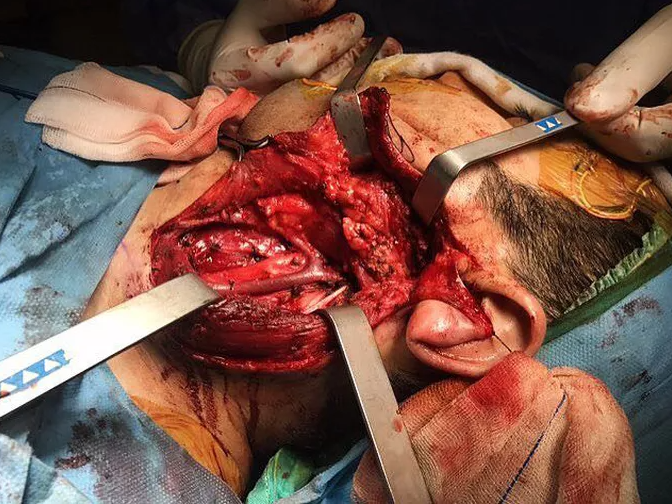 medizzycom's tweet photo. Parotidectomy and neck dissection to explore and resect a benign parotid gland tumor!

Shared in the MEDizzy App: https://t.co/25wln47ntI

#medicine #medicaleducation #anatomy #parotid https://t.co/yvf0UbwrRZ