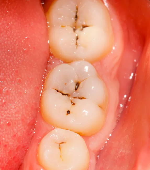 medizzycom's tweet photo. Pit and fissure cavities are commonly found on the rear molars.This is a common location for cavities because food can easily get stuck within the grooves.

Shared in the MEDizzy App: https://t.co/dfxClNH6nu

#medicine #medicaleducation #teeth #dentalcare https://t.co/WoHBRlWKLt