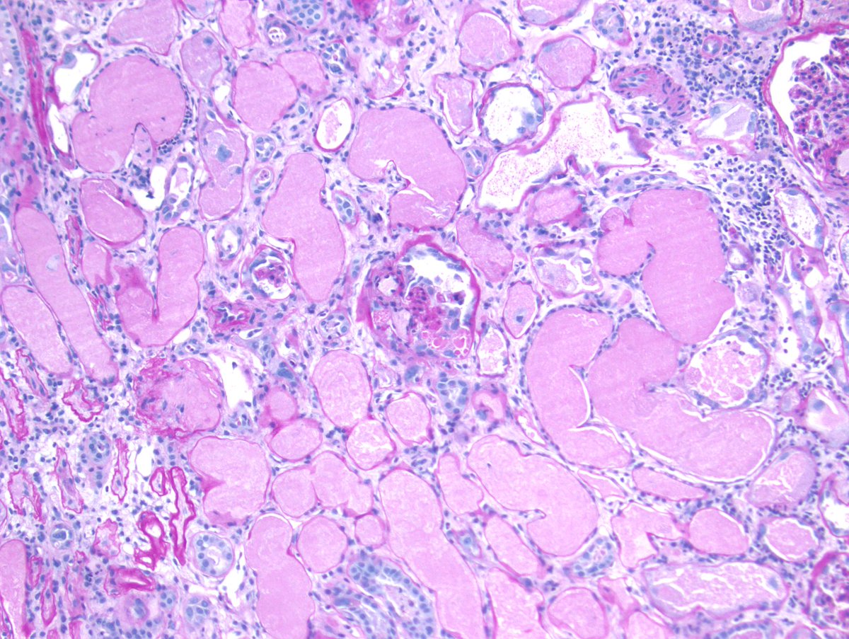 Deceased donor biopsy with prominent ATI, some areas of frank tubular necrosis, and collapsing glomerulopathy likely due to ischemia. #RenalPath