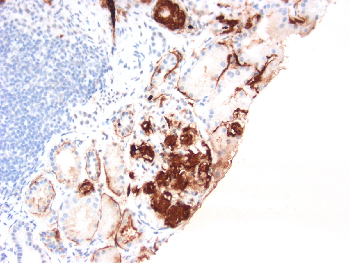 Not sure why a flood of AA-amyloid from heroin users recently. 3 cases in the last month! IHC is SAA. #RenalPath