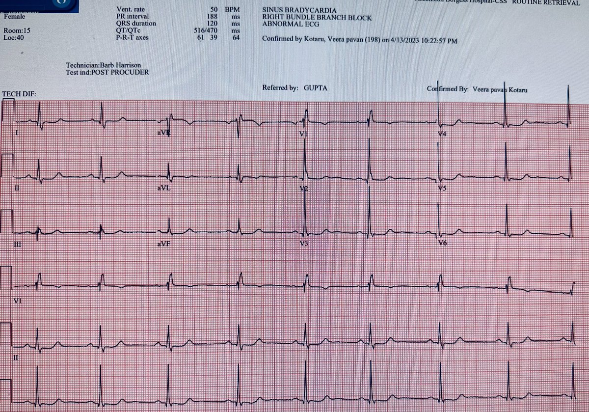 drvishalg's tweet photo. ETOH/Alcohol ablation for @HOCM still my favorite procedure! 
- 2.5cc desic 95% ethanol 
- 1000 CPK rise
- 25 Trop rise
- 72 hrs of Temp wire 
Magic happens in 6-8wks! Thanks Dr Michael Fifer @MGH for teaching me. 
#etoh_septal_ablation #HOCM #HCM
#CardioTwitter
#CardioTwitterCase
@ABH_IC_Fellows
@cardionerdsjc
@SCAI
@mirvatalasnag @AKassier
@Lcathlab
@secardiologia
@njohncamm
@indiancathtech
@PCRonline @CardioNerdsJC @CardioNerds