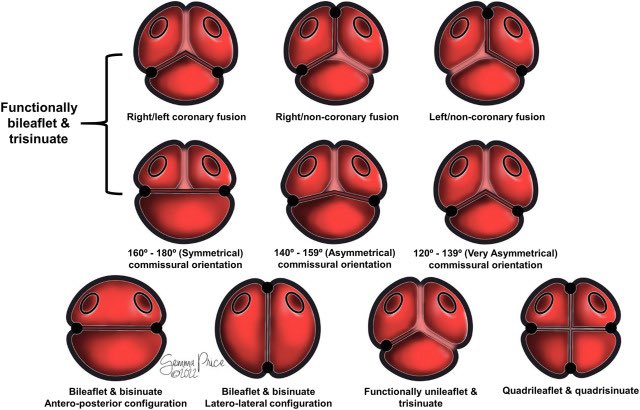 Justin T. Tretter, MD (@justintrettermd) on Twitter photo Expert consensus <a href="/annalsthorsurg/">The Annals of Thoracic Surgery</a> on #CHD of the aortic root: anatomy, imaging and nomenclature
annalsthoracicsurgery.org/article/S0003-…
Clear understanding and communication is paramount for those undergoing #aorticsurgery
<a href="/Dr_HaniNajm/">DR. Hani Najm</a> <a href="/JeffJacobs215/">Jeff Jacobs</a> <a href="/loomba_rohit/">Rohit loomba</a> <a href="/CleClinicHVTI/">Cleveland Clinic Heart, Vascular & Thoracic</a> <a href="/EricRoselliMD/">Eric E. Roselli</a> Expert consensus <a href="/annalsthorsurg/">The Annals of Thoracic Surgery</a> on #CHD of the aortic root: anatomy, imaging and nomenclature
annalsthoracicsurgery.org/article/S0003-…
Clear understanding and communication is paramount for those undergoing #aorticsurgery
<a href="/Dr_HaniNajm/">DR. Hani Najm</a> <a href="/JeffJacobs215/">Jeff Jacobs</a> <a href="/loomba_rohit/">Rohit loomba</a> <a href="/CleClinicHVTI/">Cleveland Clinic Heart, Vascular & Thoracic</a> <a href="/EricRoselliMD/">Eric E. Roselli</a>