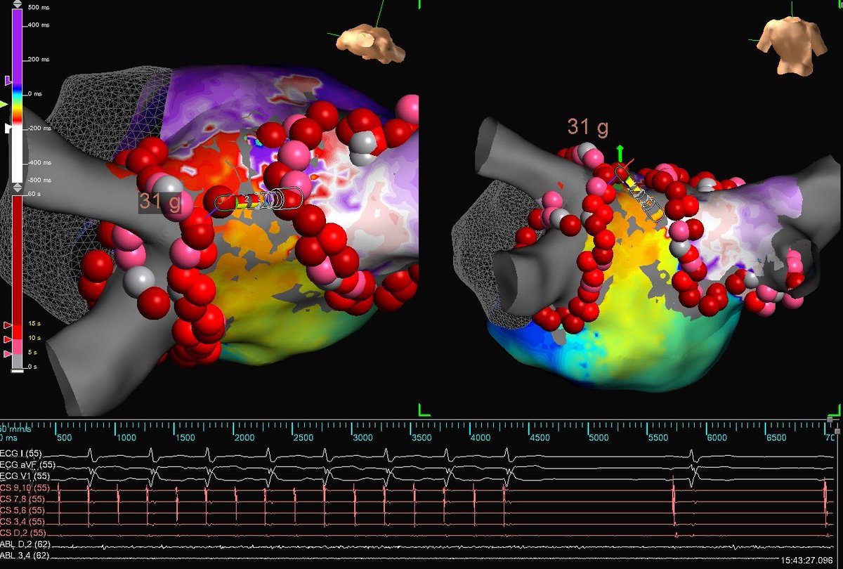 HomeyerKatie's tweet image. Great first #TactiFlex PVI case in South Florida with @dkenigsberg! Added bonus was a fun circuit that terminated with one burn on #EnsiteX. @abbottcardio @GatorPacer @meghapandyaep 

#EPeeps #AbbottProud