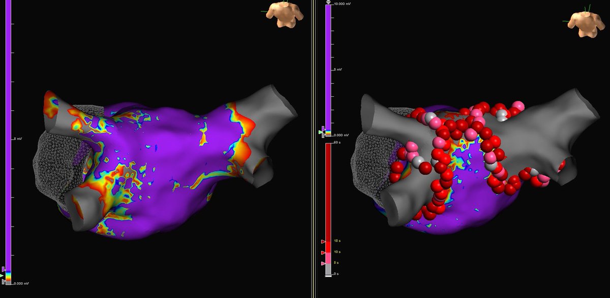 HomeyerKatie's tweet image. Great first #TactiFlex PVI case in South Florida with @dkenigsberg! Added bonus was a fun circuit that terminated with one burn on #EnsiteX. @abbottcardio @GatorPacer @meghapandyaep 

#EPeeps #AbbottProud