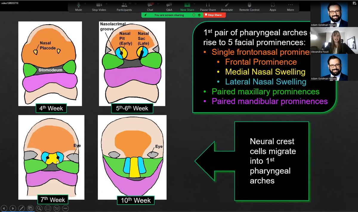 Thank you <a href="/alexandra_foust/">Alexandra Foust</a> for the incredible talk with some amazing cases! It is important to understand the embryology to help us understand what we are are seeing on imaging.  

If you missed it: youtube.com/@PEANUTSlectur…