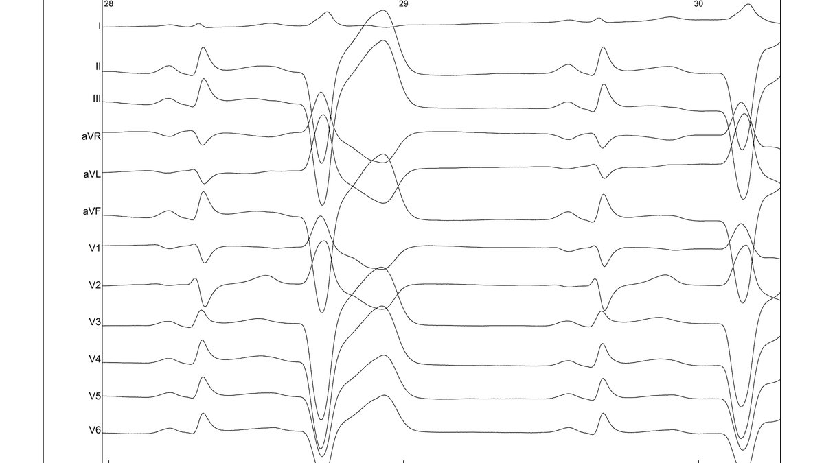 Santi_herher's tweet photo. Amazing origin of this PVC in the moderator band, with positive R wave in V1-V2🤪 with @JosMorenoArrib1 @MargaBruiz @javiersamp https://t.co/w0waU6AKcp