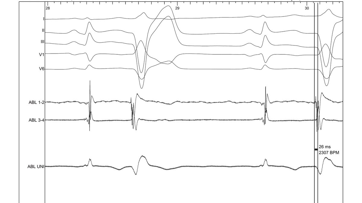 Santi_herher's tweet photo. Amazing origin of this PVC in the moderator band, with positive R wave in V1-V2🤪 with @JosMorenoArrib1 @MargaBruiz @javiersamp https://t.co/w0waU6AKcp
