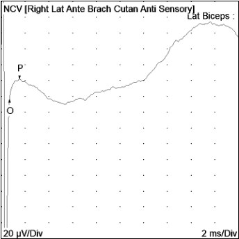 𝘾𝙖𝙨𝙚 𝙤𝙛 𝙩𝙝𝙚 𝙒𝙚𝙚𝙠 from <a href="/ShaneDavisMD/">Shane M. Davis, MD</a> of <a href="/TuftsMedicalCtr/">Tufts Medical Center</a>

A 22-year-old ⚾️ pitcher presents with 1 day of right distal biceps pain which occurred immediately after throwing. +TTP, ⬇️sensation over the lateral forearm. What is the diagnosis?

tinyurl.com/yc45s583
