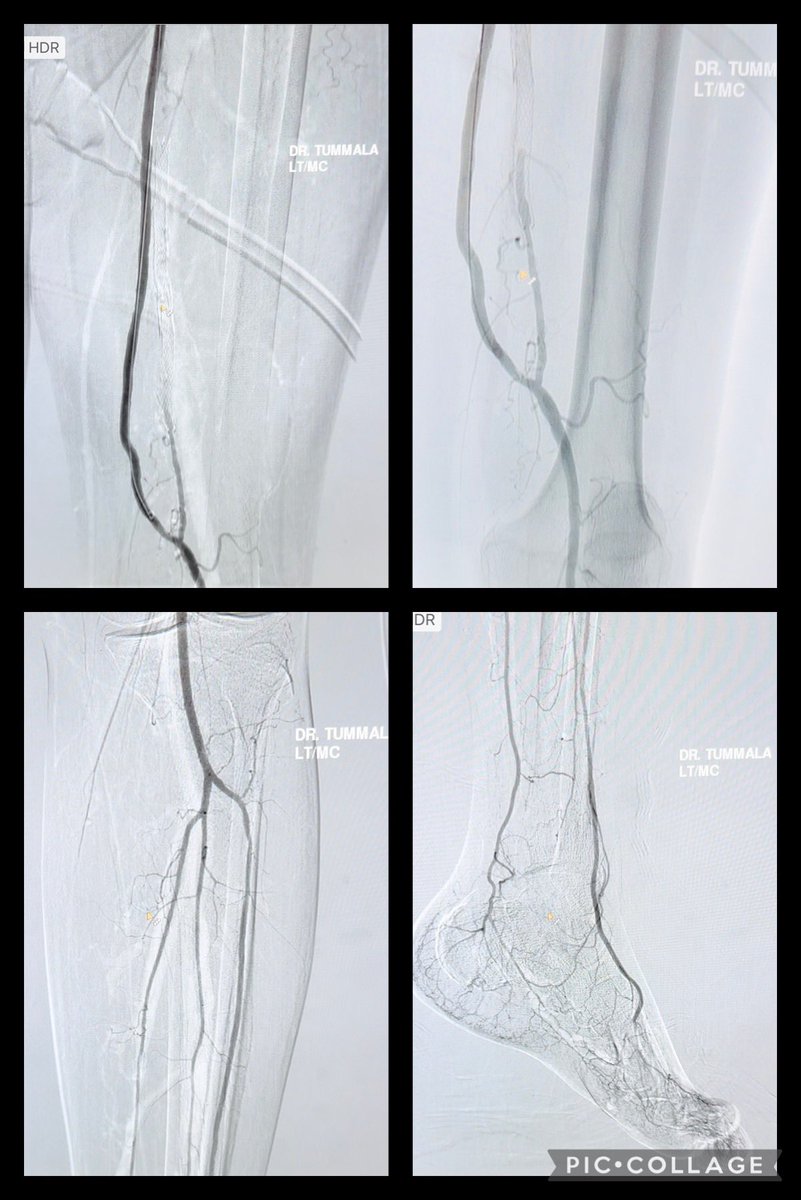 t_intheleadcoat's tweet photo. Great discussion &amp; appreciate all input. 
CTA…
1. No aortoiliac flow limiting dz
2. Profunda occluded for cm’s. Explains why profunda salvage at REDO by VS unsuccessful.
3. Thrombectomy followed by thrombolysis successfully alleviated patient symptoms. Thought worth a share. https://t.co/fMWZecTkl5