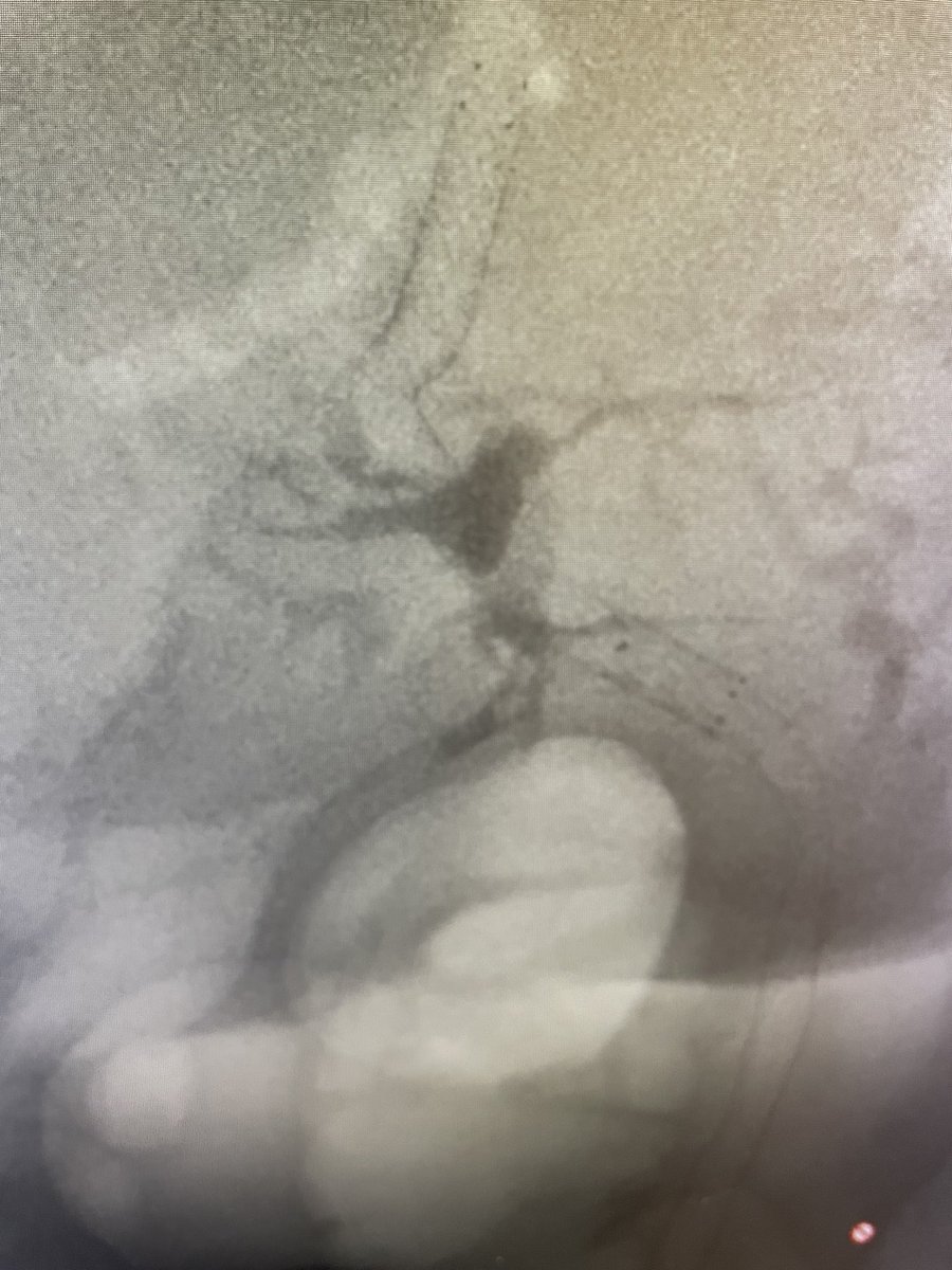 Met liver disease w left lobe obliteration + right sided duct dilation. Multi-focal duct strictures extending to ampulla. Treated w overlapping uncovered Epic stents by @bostonsci for palliation. #GITwitter