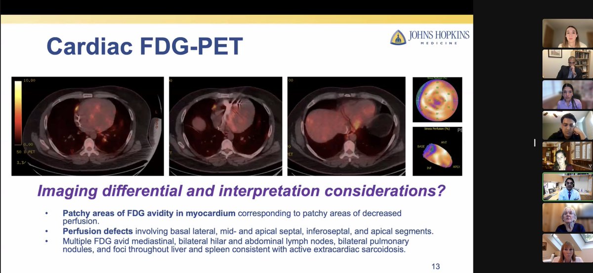 @hopkinsheart Chief Fellow @JLovellMD walking us through a #cardiacsarcoidosis case with our expert panel @JonChrispinMD @sanjaydivakaran @dawn_pedrotty @ParijatSen11