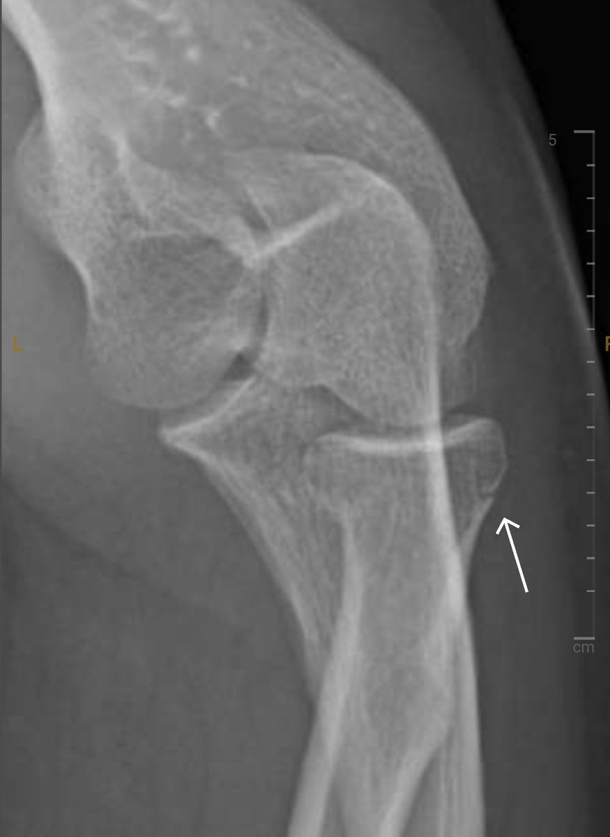 As my vacation comes to a wrap, I wanted to share that 90 minutes into the start of my vacation, I fell and fractured my radial head (basically broke my elbow). The red shows edema pouch and second pic you can see part of the break. Worst vacation ever 😪