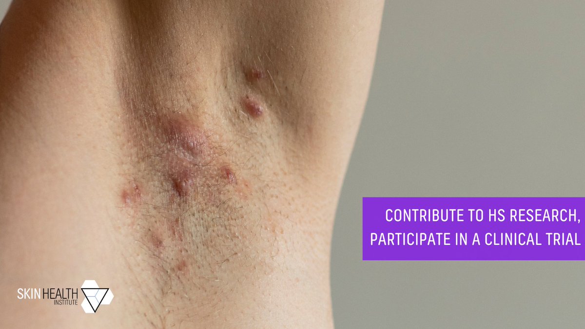 The #skinhealthinstitute have upcoming clinical trial opportunities for people with #HidradenitisSuppurativa that meet eligibility criteria.

For more information, you can contact Sarah Chivers at schivers@skinhealthinstitute.org.au 

#HSAwarenessWeek #referapatient