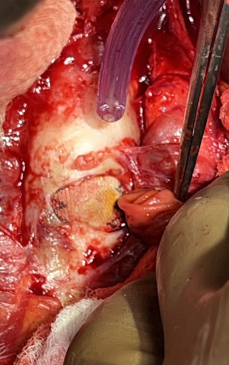 Dacron grafts should not be green.  Orange yes - #teamorange - but not green.  Screen right is the sizeable hole in the duodenum.  #aorta #aortaed