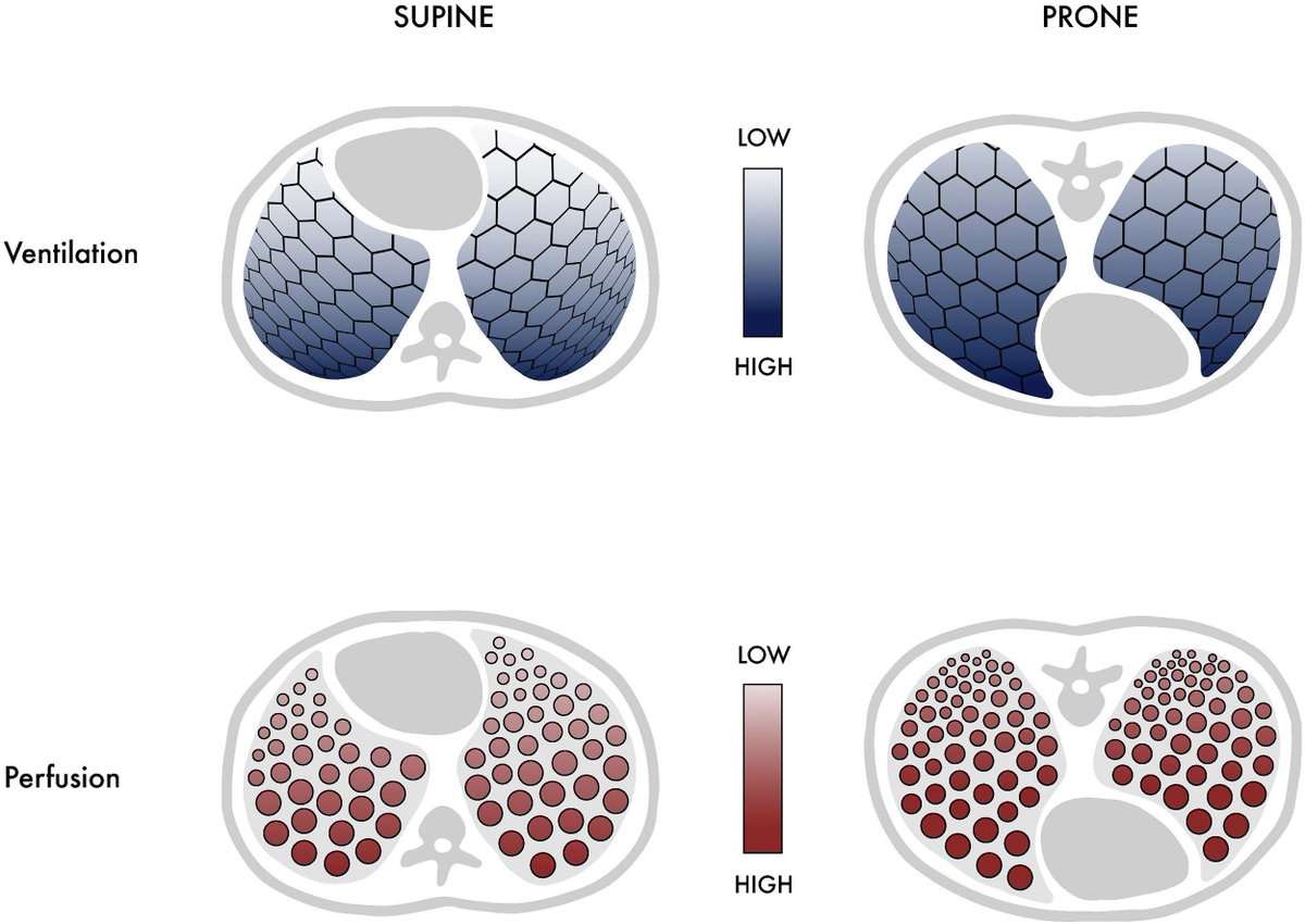Prone Positioning for Acute Hypoxemic Respiratory Failure and ARDS: A Review
🔗sciencedirect.com/science/articl…
👇Diagram showing the effect of the prone position on ventilation and perfusion.
#MedEd #FOAMed #FOAMcc