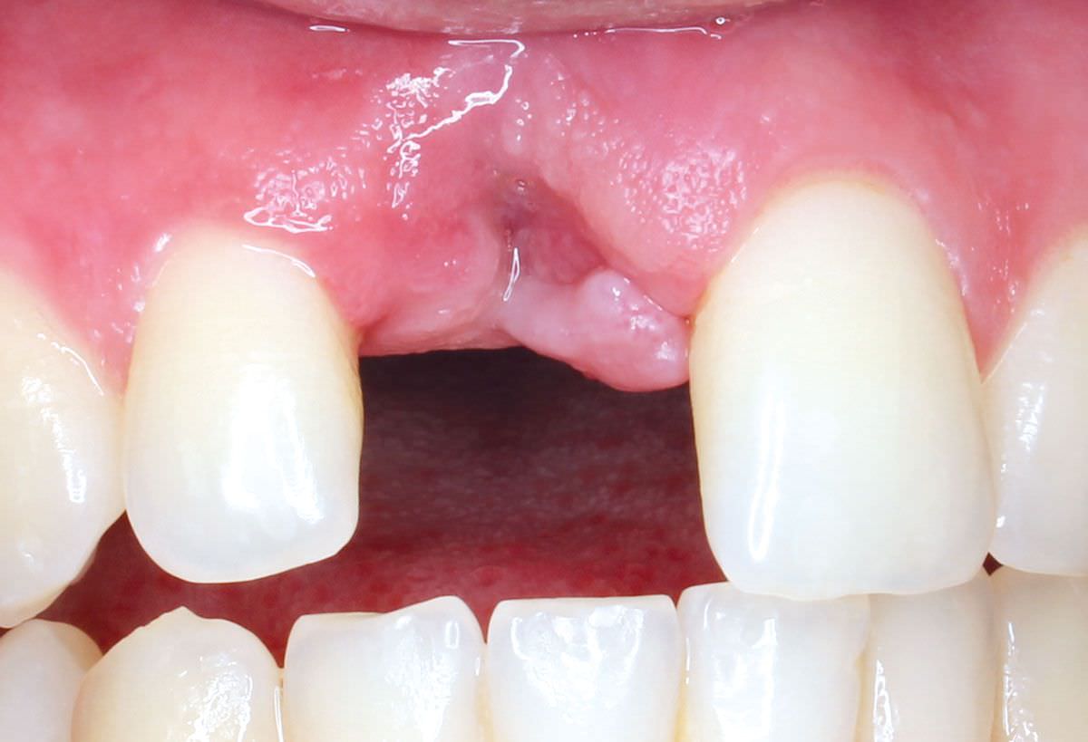 This customization fosters a positive mindset and encourages individuals to embrace their orthodontic journey as an exciting transformation rather than a burden. 
#dental #dentist #dentistry #smile #teeth #dentista #odontologia #dentalcare #tooth 
rb.gy/rzdn8