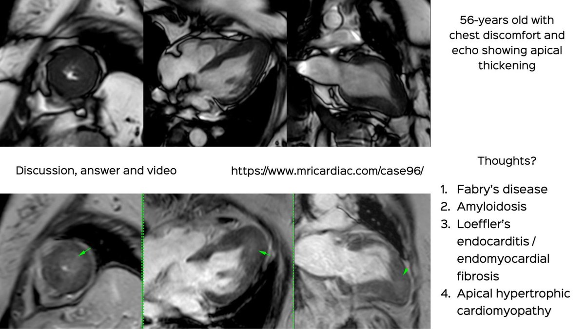 56-years old with chest discomfort and apical thickening on echo

Thoughts?
1. Fabry's
2. Amyloid
3. EMF
4. Apical HCM

Discussion , answer and video
mricardiac.com/case96/

#cmrsimplified #cmr #cardiacmri #radres #FOAMrad