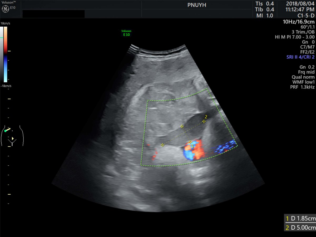 CEOGjournal's tweet photo. IMR Press / CEOG / Volume 49 / Issue 12
Dong Hyung Lee, et al. analyzed a case about "Placental Abruption with Subamniotic Hemorrhage".
You can read more details at
https://t.co/428gQlhL81
#placental_abruption
#subamniotic_hemorrhage
#ultrasound
#vaginal_bleeding https://t.co/nCfztefhUg