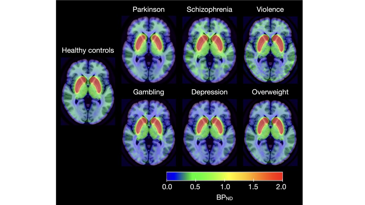 RT @LNummenmaa How specific are dopaminergic alterations across psychiatric, neurological, and other conditions? Not very specific per new @TurkuPETCentre @UniTurku  preprint based on (n=437) large-scale PET database: https://t.co/Eo4LehsHj0