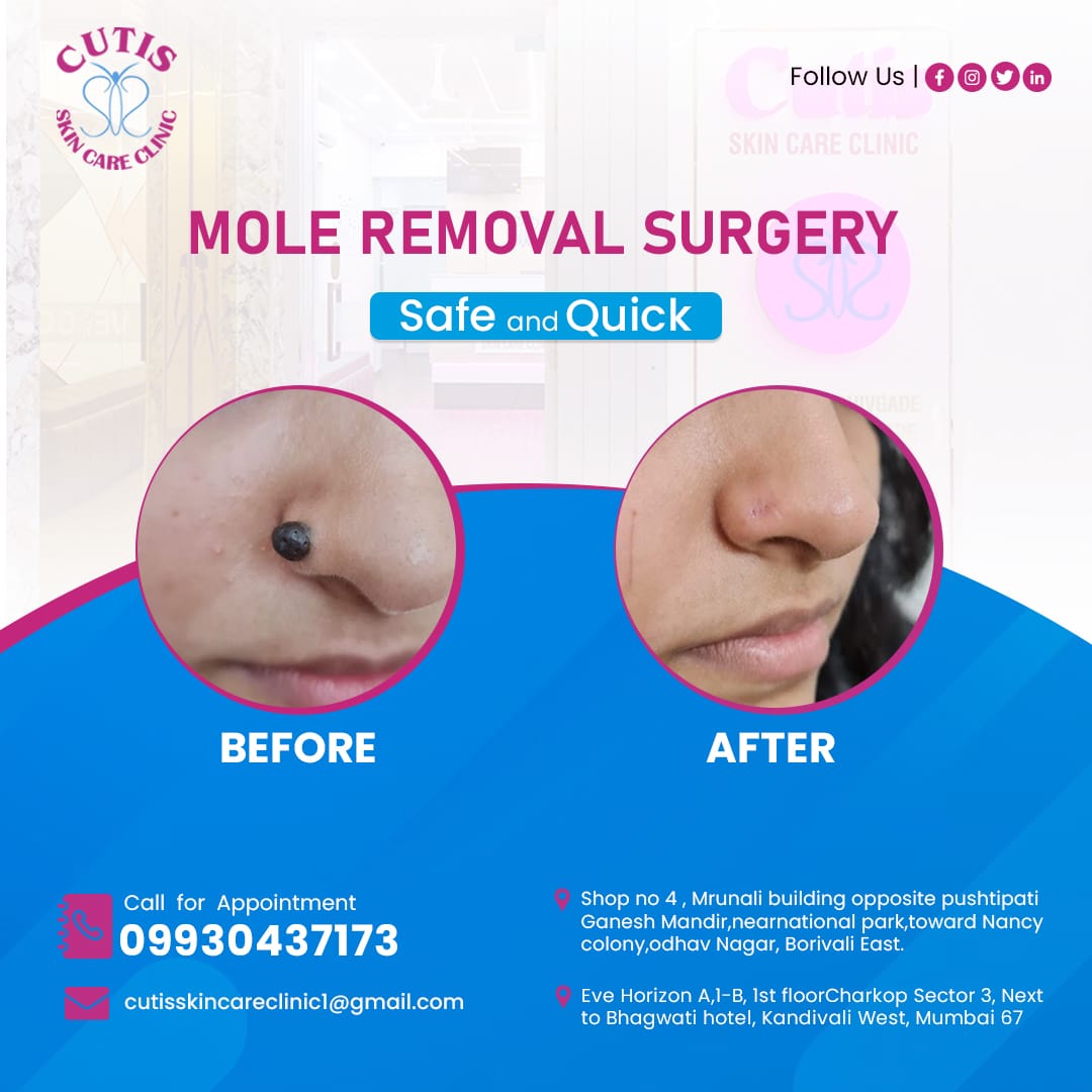 Cutis Skin Care Clinic Mole Removal Surgery

Book appointment Today!
Cutis Skin Care Clinic
Call us - +91 9930437173

#SkinSpecialist #FlawlessSkin #SatisfiedCustomers #ResultsThatMatte #cutiesLaserSkinandHairClinic #Saanvis #acnescars #AcneScarsTreatment #AcneTreatment #carbon