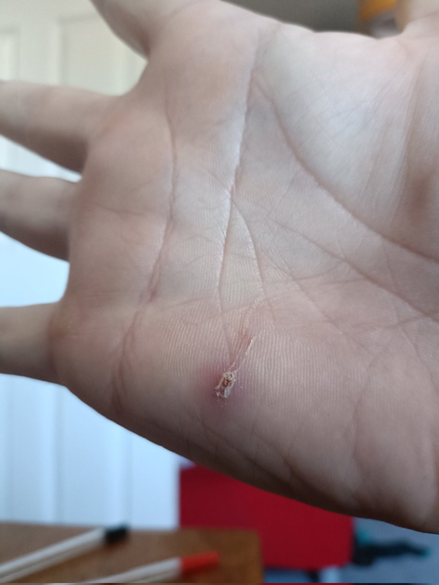 Sometimes squash layoffs are for the silliest of reasons, like a small splinter on your playing hand...