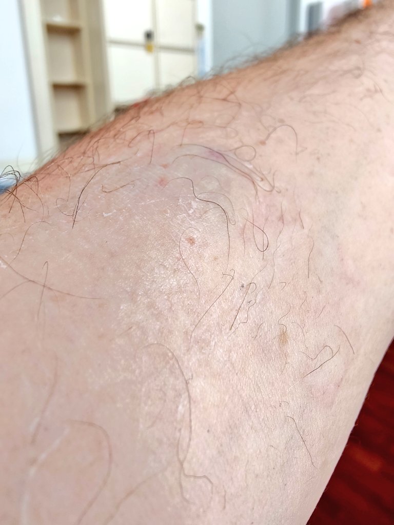 Heute Blutabnahme aus der Hölle. Bekomme alle drei Monate Blut abgenommen,also habe schon viele Einstiche hinter mir. Aber so schlimm,wie es heute war (und heute Nachmittag/Abend/Nacht/Morgen wird) ist es noch nie gewesen. Die Vene ist dann wohl geplatzt,sagen die hier im KKH 🙄