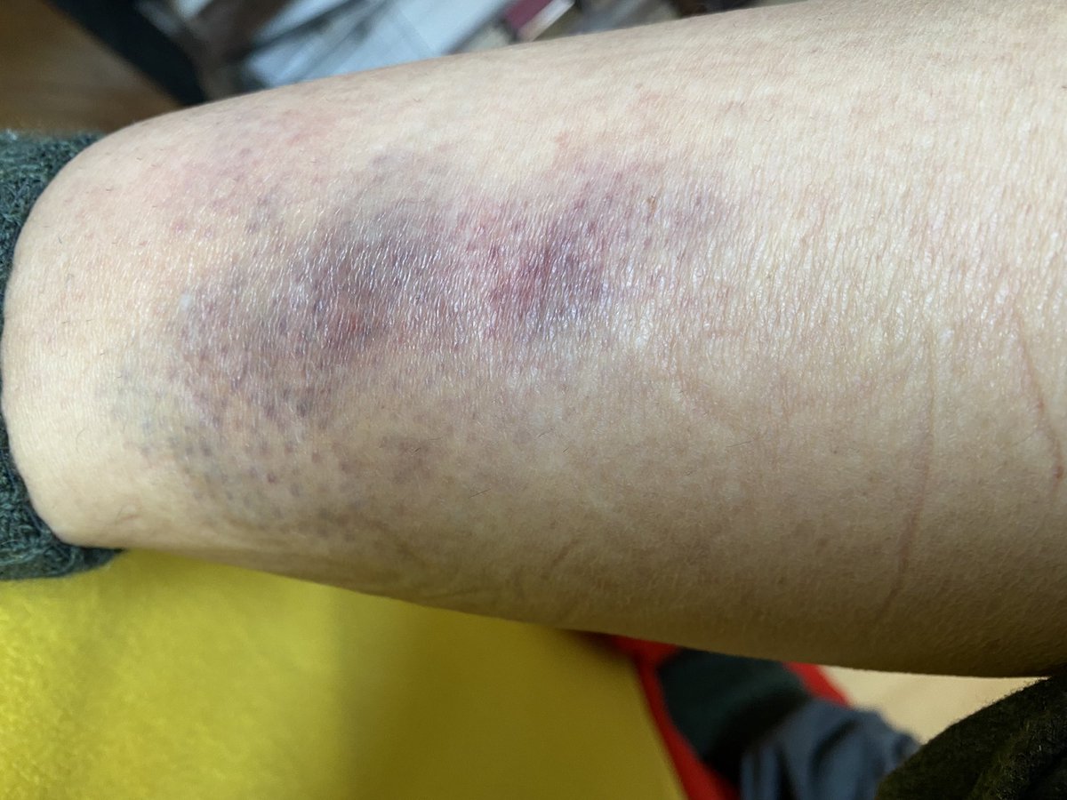 Stéphanie Hochet (@stephaniehochet) on Twitter photo Madame <a href="/Anne_Hidalgo/">Anne Hidalgo</a> 
Puis-je vous importuner avec des photos d’un corps violemment renversé par un vélo électrique qui allait comme vous le souhaitez à contresens des véhicules motorisés (voitures et motos).
Les rues de #Paris sont bordées de véhicules stationnant qui empêche la Madame <a href="/Anne_Hidalgo/">Anne Hidalgo</a> 
Puis-je vous importuner avec des photos d’un corps violemment renversé par un vélo électrique qui allait comme vous le souhaitez à contresens des véhicules motorisés (voitures et motos).
Les rues de #Paris sont bordées de véhicules stationnant qui empêche la