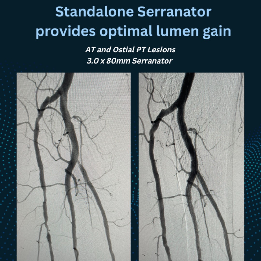 Standalone #Serranator saves this AT and ostial PT lesions to provide blood flow to the foot.  No predilatation, atherectomy or stend was required in order to achieve this excellent lumen gain.  #SerrateAndInflate