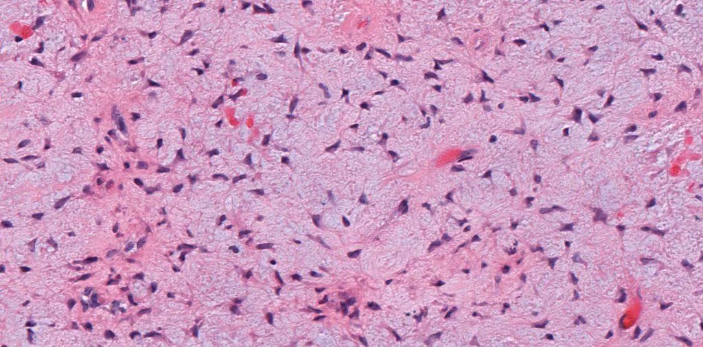 20 yo M w/ 5 cm lytic bone lesion in proximal tibia metaphysis, sharply demarcated w/ sclerotic rim. WSI digital slide: kikoxp.com/posts/4606. Your diagnosis? Answer & video:  kikoxp.com/posts/4739.  #BSTpath #radpathmatch #radiology #pathology #pathTwitter #orthotwitter