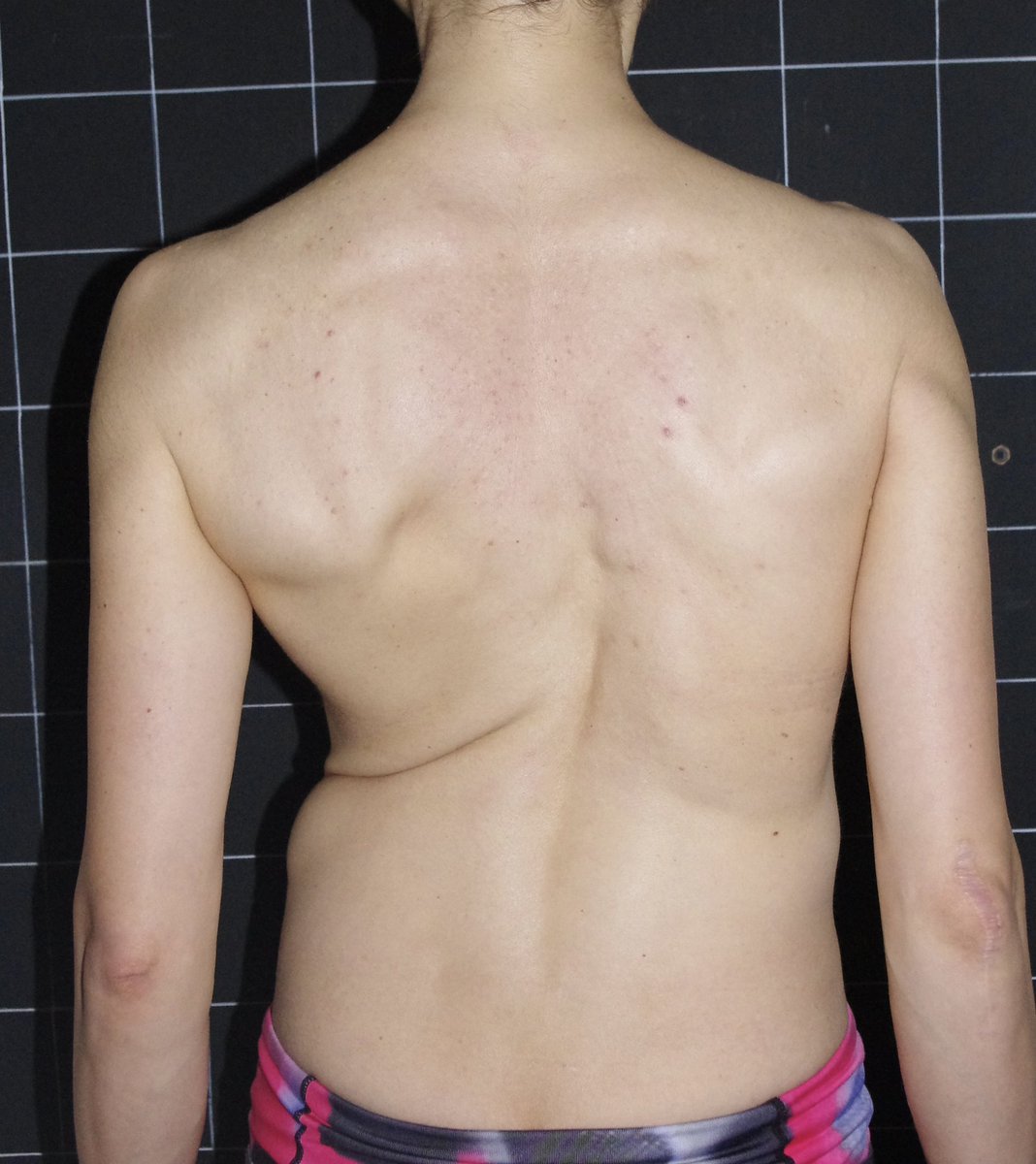 𝗥𝗲𝘀𝘂𝗹𝘁𝘀

Check out these 𝗔𝗠𝗔𝗭𝗜𝗡𝗚 results from one of our recent 4 week finishers! 

#ScoliosisSOS