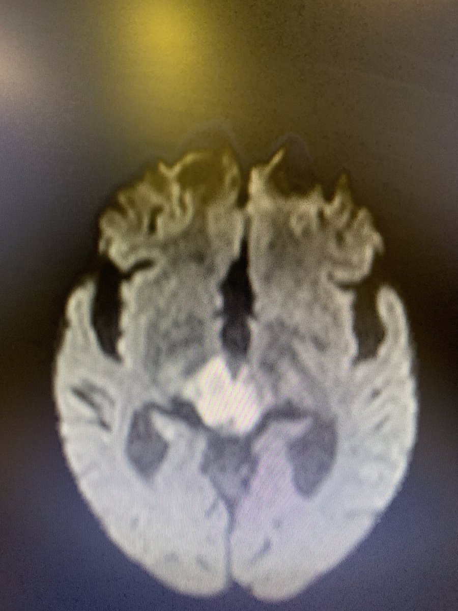 bobvarkey's tweet image. Unusual presentation of stroke- sudden cardiac arrest- reversed after 6 cycles of CPR, persistent sinus bradycardia after. Referred as hypoxic encephalopathy. MRI - midbrain and Bithalamic infarction with basilar occlusion