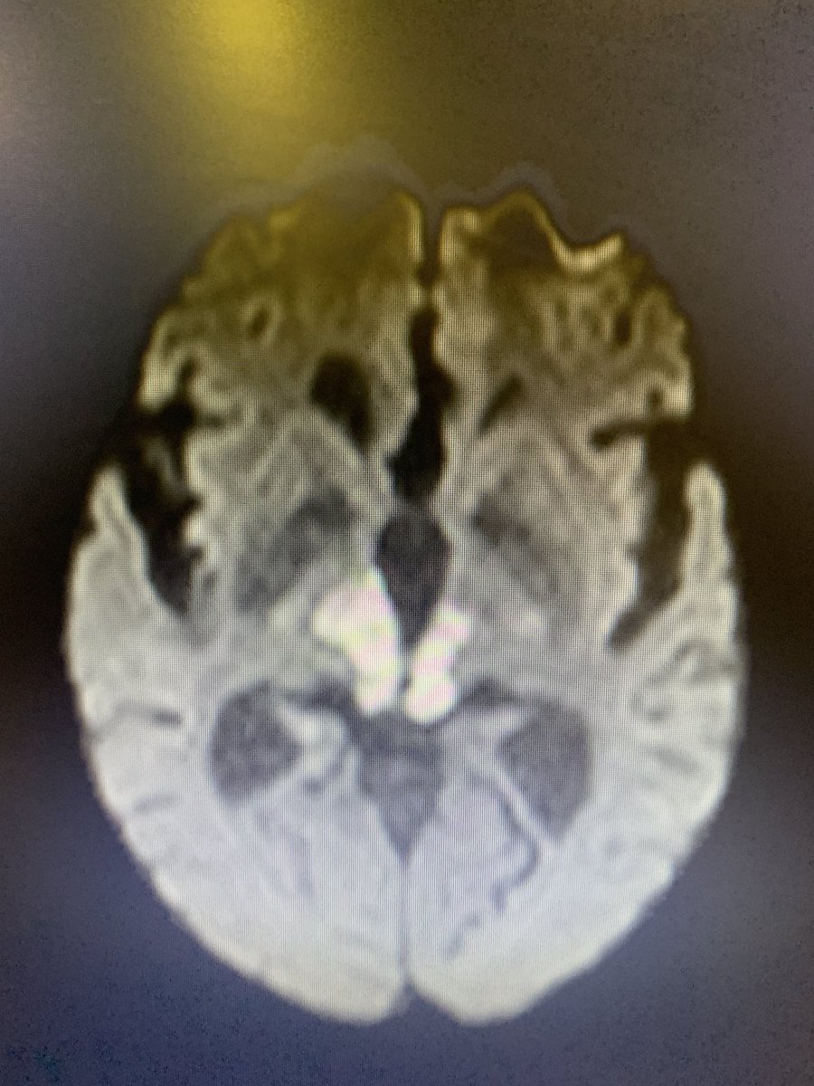 bobvarkey's tweet image. Unusual presentation of stroke- sudden cardiac arrest- reversed after 6 cycles of CPR, persistent sinus bradycardia after. Referred as hypoxic encephalopathy. MRI - midbrain and Bithalamic infarction with basilar occlusion