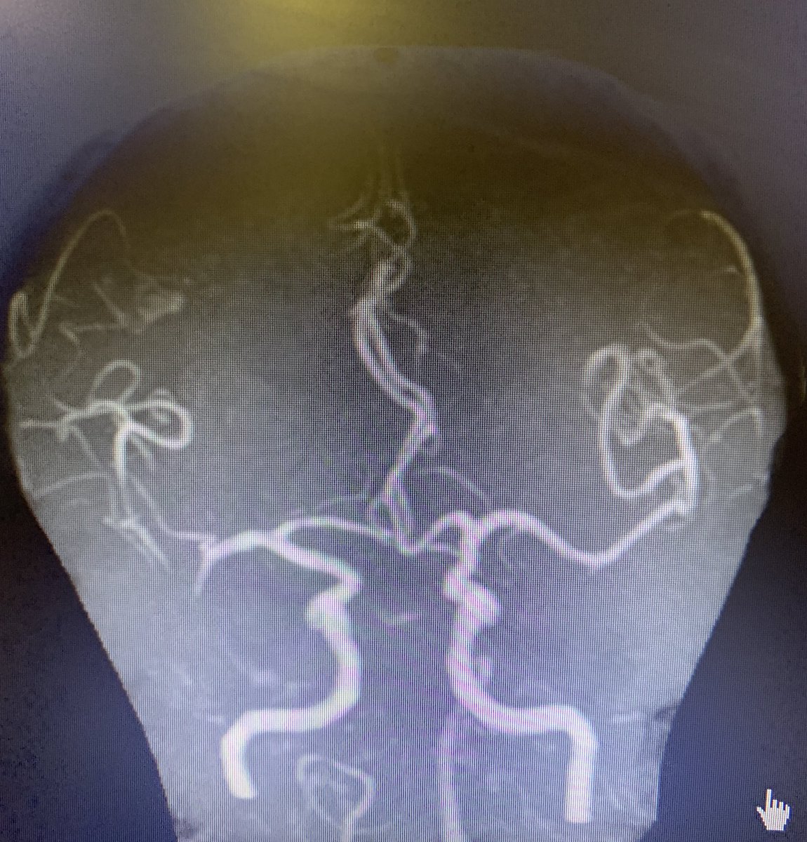 bobvarkey's tweet image. Unusual presentation of stroke- sudden cardiac arrest- reversed after 6 cycles of CPR, persistent sinus bradycardia after. Referred as hypoxic encephalopathy. MRI - midbrain and Bithalamic infarction with basilar occlusion