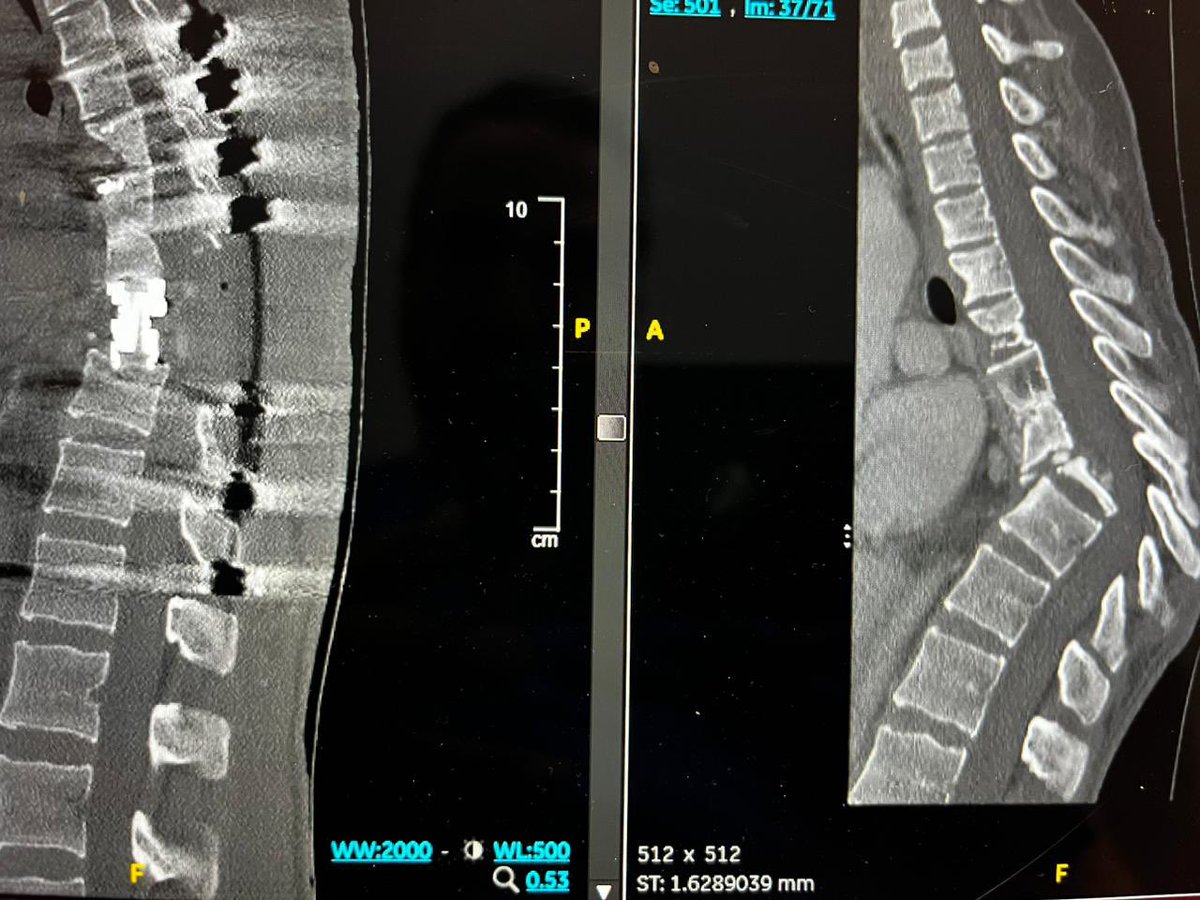 KFMC_RIYADH's tweet photo. إنقاذ فتاة من تشوه في العمود الفقري في #مدينة_الملك_فهد_الطبية 

#واس
#تجمع_الرياض_الصحي_الثاني 

https://t.co/kTx9W9hQOm https://t.co/n1nCz6tbJu