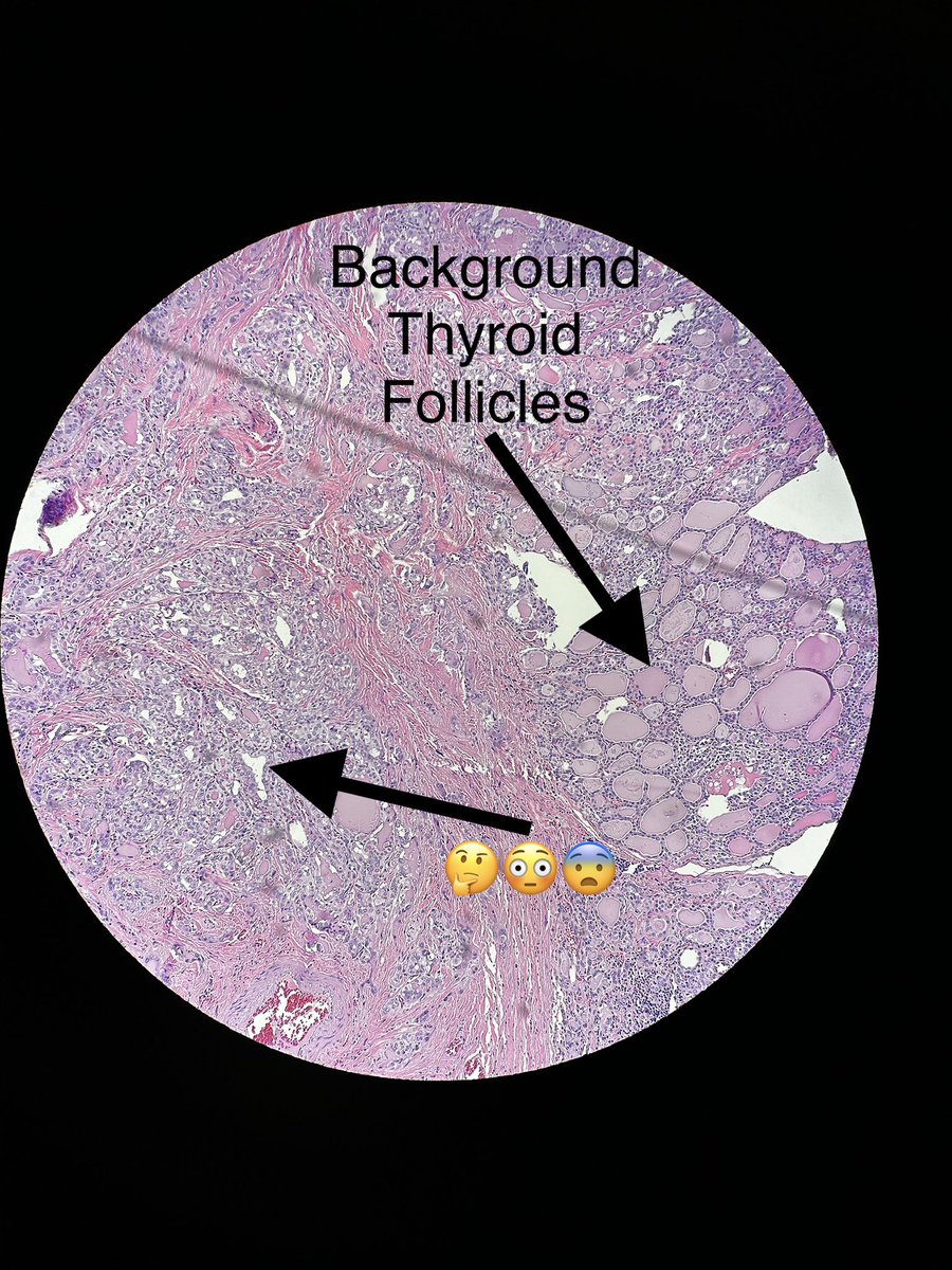 Path4People's tweet photo. #casestudyfriday ๐๐ผ๐
We received a #thyroid specimen from a 38 year old female with #hashimotoโs thyroiditis and #goiter (4 cm).
Here is what we saw under the microscope. Any thoughts?
Dx: https://t.co/TC2PwyeZn6
#path4people
#hashimoto
#ent #headandneck #pathology https://t.co/WqkoiVgJsw