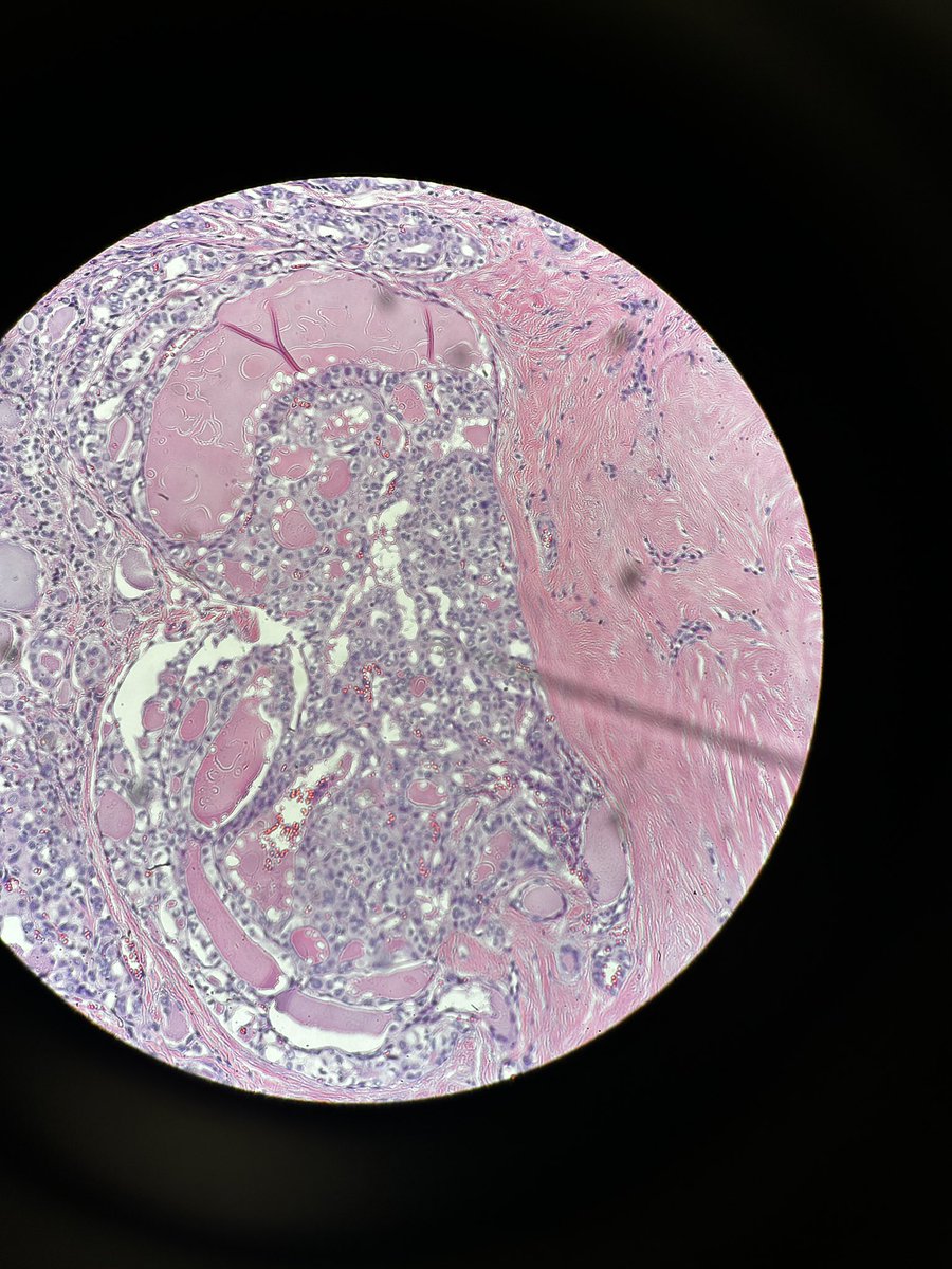 Path4People's tweet photo. #casestudyfriday ๐๐ผ๐
We received a #thyroid specimen from a 38 year old female with #hashimotoโs thyroiditis and #goiter (4 cm).
Here is what we saw under the microscope. Any thoughts?
Dx: https://t.co/TC2PwyeZn6
#path4people
#hashimoto
#ent #headandneck #pathology https://t.co/WqkoiVgJsw