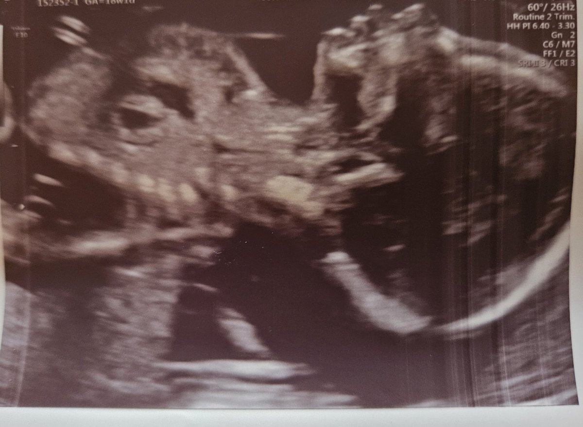 214g Liebe im Bauch ❤️, alles soweit unauffällig, Hirnstrukturen konnten nicht beurteilt werden, da Köpfchen rechts im Becken, aber das erste Bild vom Profil 😍