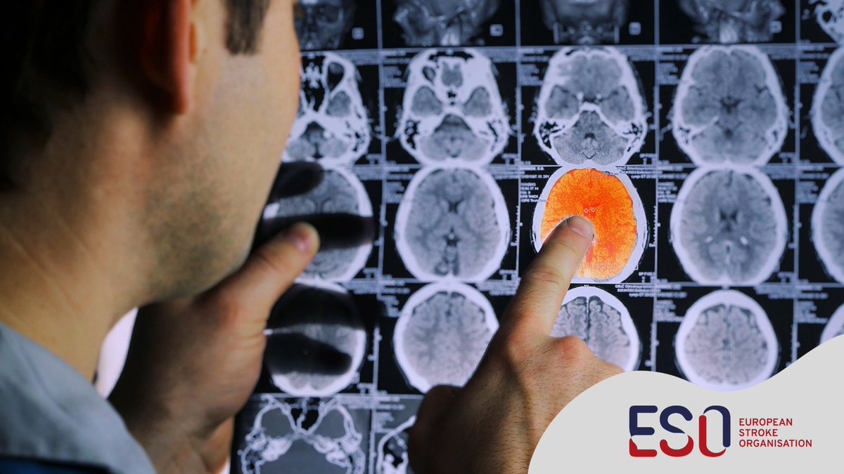European Stroke Org (@esostroke) on Twitter photo 👉The new must-read #ESOblog is out today!
In this week's blog, <a href="/vojtech_no/">Vojtech Novotny</a> discusses the role of micro-emboli detection in the management of ischaemic stroke.
Read the article: ow.ly/Zw3v50OJRZf
#stroke #strokeresearch #stroketreatment #strokecare <a href="/UiB/">Universitetet i Bergen</a> #StrokeTwitter 👉The new must-read #ESOblog is out today!
In this week's blog, <a href="/vojtech_no/">Vojtech Novotny</a> discusses the role of micro-emboli detection in the management of ischaemic stroke.
Read the article: ow.ly/Zw3v50OJRZf
#stroke #strokeresearch #stroketreatment #strokecare <a href="/UiB/">Universitetet i Bergen</a> #StrokeTwitter
