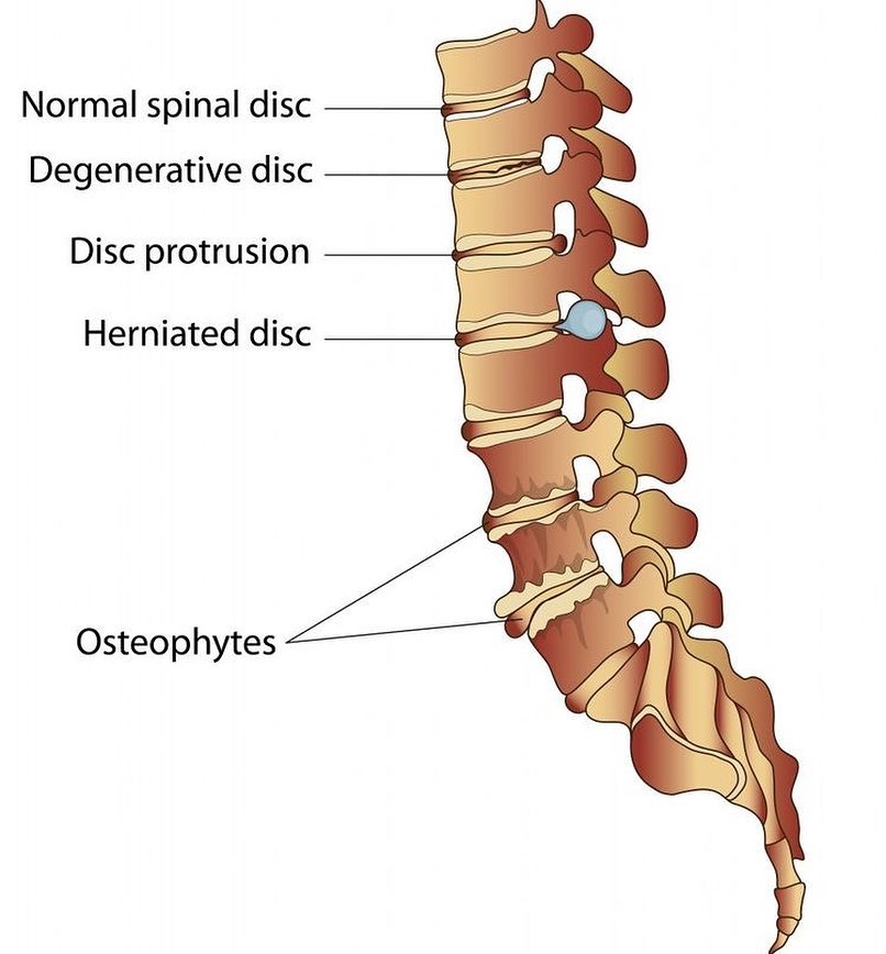 Physio_online_1's tweet image. Different types of disc 👈
#disc #spinaldisc
