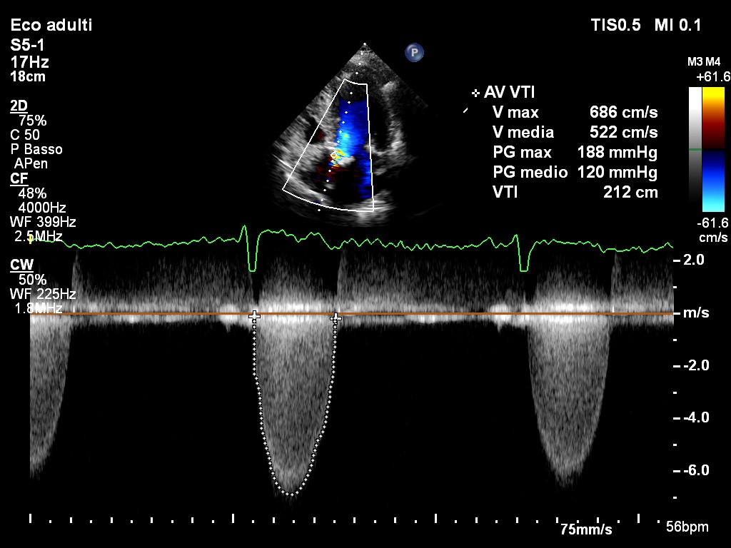 188/120 mmHg...  Hypertensive Urgency or Aortic Stenosis? #echofirst
