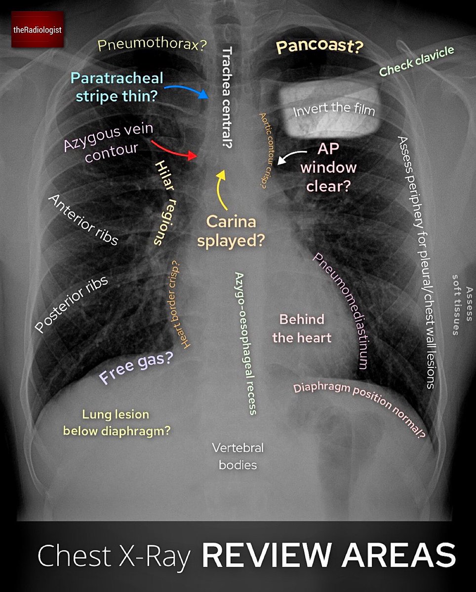 Chest Xray anatomy and review areas @radiologistpage #FOAMed